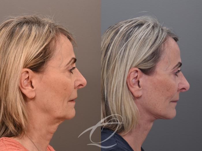 Facelift Case 1002022 Before & After Right Side | Serving Rochester, Syracuse & Buffalo, NY | Quatela Center for Plastic Surgery