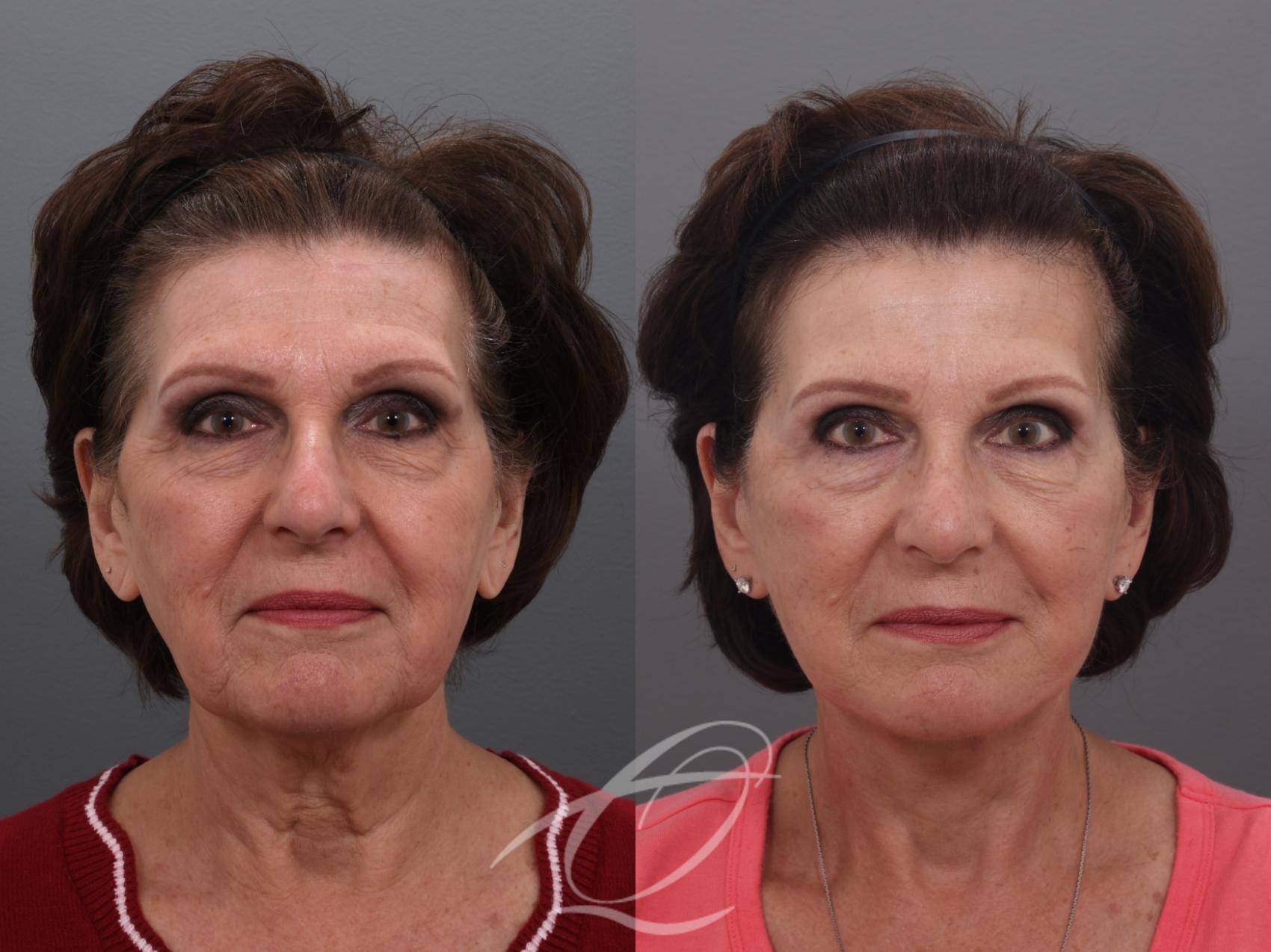 Facelift Case 1002032 Before & After Front | Serving Rochester, Syracuse & Buffalo, NY | Quatela Center for Plastic Surgery