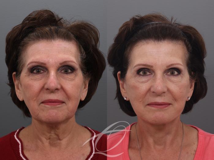 Facelift Case 1002032 Before & After Front | Serving Rochester, Syracuse & Buffalo, NY | Quatela Center for Plastic Surgery