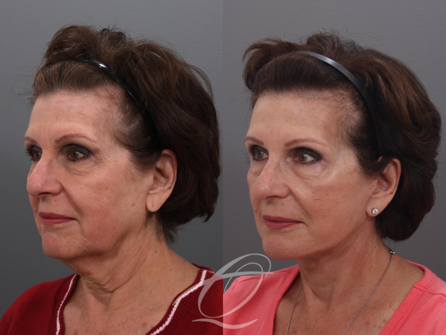 Facelift Case 1002032 Before & After Left Oblique | Serving Rochester, Syracuse & Buffalo, NY | Quatela Center for Plastic Surgery