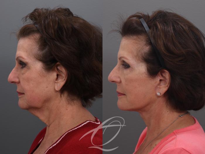 Facelift Case 1002032 Before & After Left Side | Serving Rochester, Syracuse & Buffalo, NY | Quatela Center for Plastic Surgery