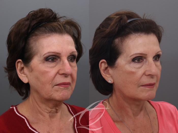 Facelift Case 1002032 Before & After Right Oblique | Serving Rochester, Syracuse & Buffalo, NY | Quatela Center for Plastic Surgery