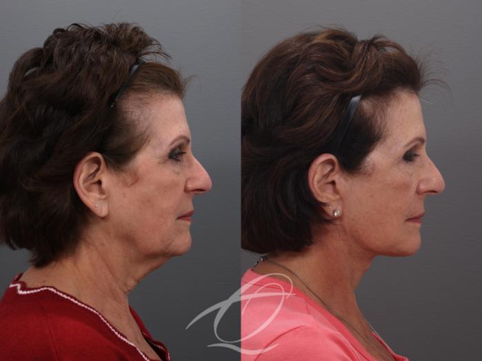 Facelift Case 1002032 Before & After Right Side | Serving Rochester, Syracuse & Buffalo, NY | Quatela Center for Plastic Surgery