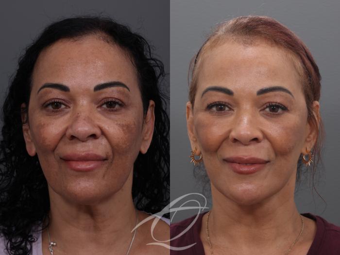 Facelift Case 1002033 Before & After Front | Serving Rochester, Syracuse & Buffalo, NY | Quatela Center for Plastic Surgery