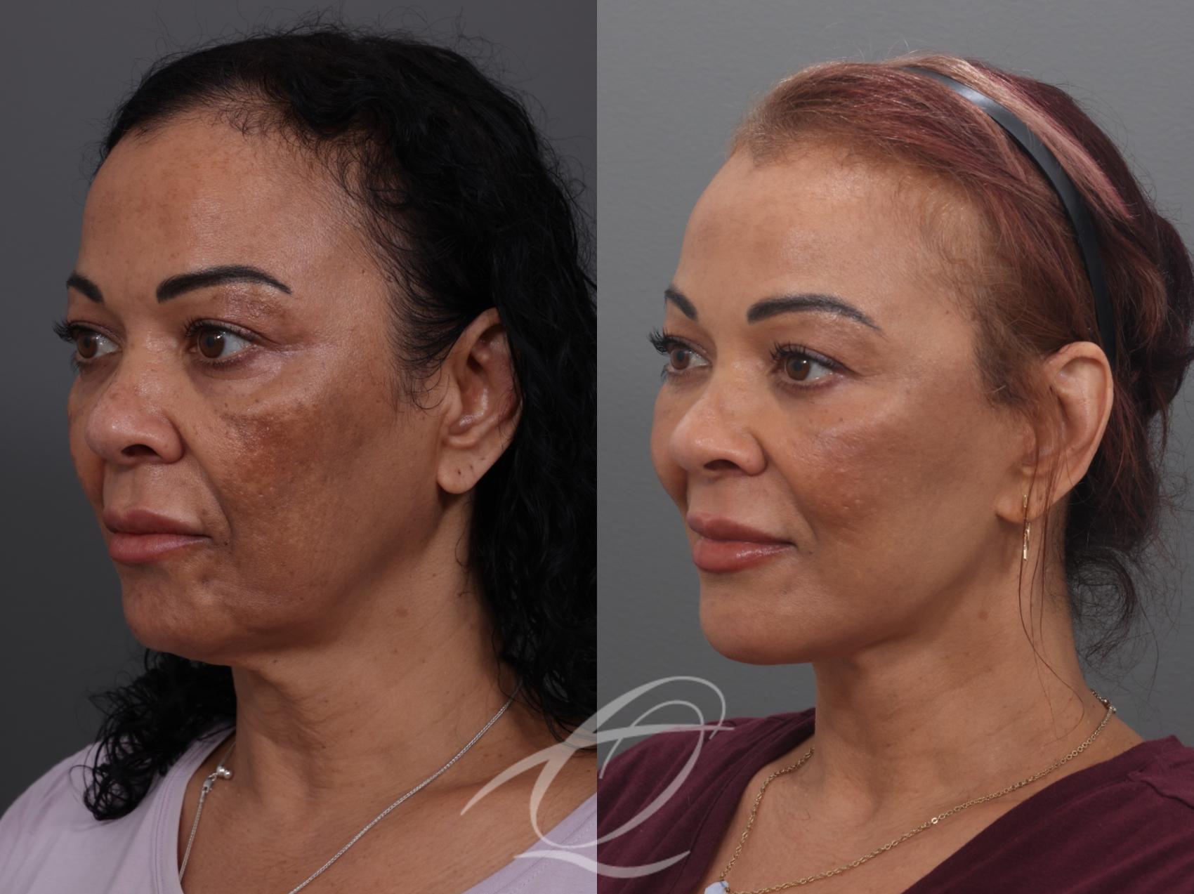 Facelift Case 1002033 Before & After Left Oblique | Serving Rochester, Syracuse & Buffalo, NY | Quatela Center for Plastic Surgery
