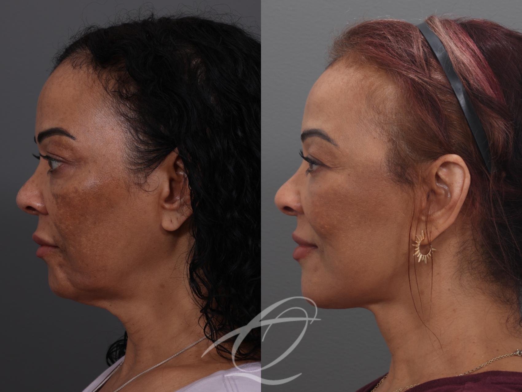 Facelift Case 1002033 Before & After Left Side | Serving Rochester, Syracuse & Buffalo, NY | Quatela Center for Plastic Surgery