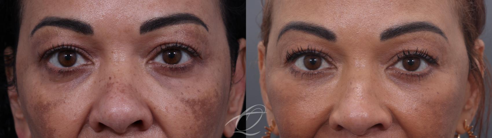 Facelift Case 1002033 Before & After Lower blepharoplasty | Serving Rochester, Syracuse & Buffalo, NY | Quatela Center for Plastic Surgery