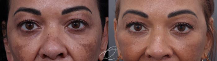 Facelift Case 1002033 Before & After Lower blepharoplasty | Serving Rochester, Syracuse & Buffalo, NY | Quatela Center for Plastic Surgery