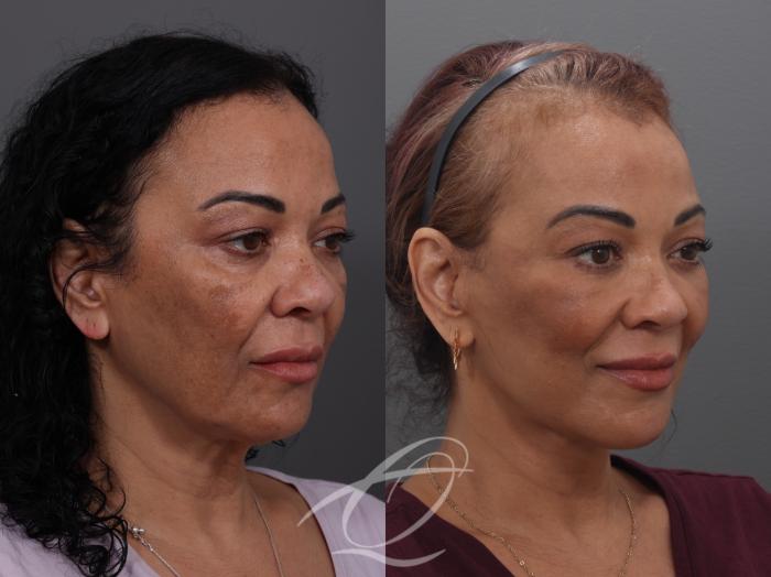 Facelift Case 1002033 Before & After Right Oblique | Serving Rochester, Syracuse & Buffalo, NY | Quatela Center for Plastic Surgery