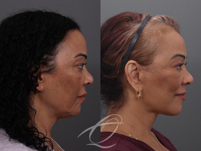 Facelift Case 1002033 Before & After Right Side | Serving Rochester, Syracuse & Buffalo, NY | Quatela Center for Plastic Surgery