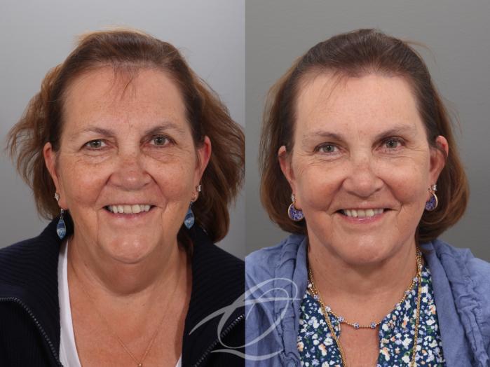 Facelift Case 1002034 Before & After Front | Serving Rochester, Syracuse & Buffalo, NY | Quatela Center for Plastic Surgery