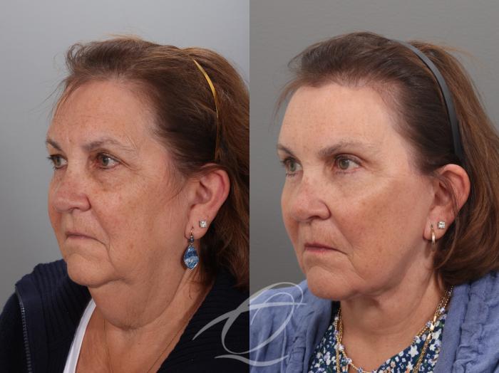 Facelift Case 1002034 Before & After Left Oblique | Serving Rochester, Syracuse & Buffalo, NY | Quatela Center for Plastic Surgery