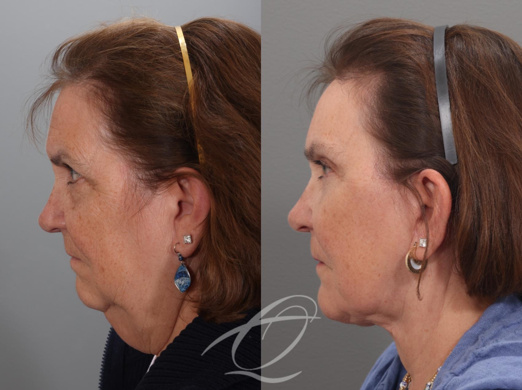 Facelift Case 1002034 Before & After Left Side | Serving Rochester, Syracuse & Buffalo, NY | Quatela Center for Plastic Surgery