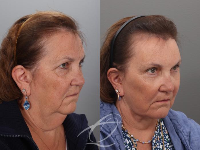 Facelift Case 1002034 Before & After Right Oblique | Serving Rochester, Syracuse & Buffalo, NY | Quatela Center for Plastic Surgery
