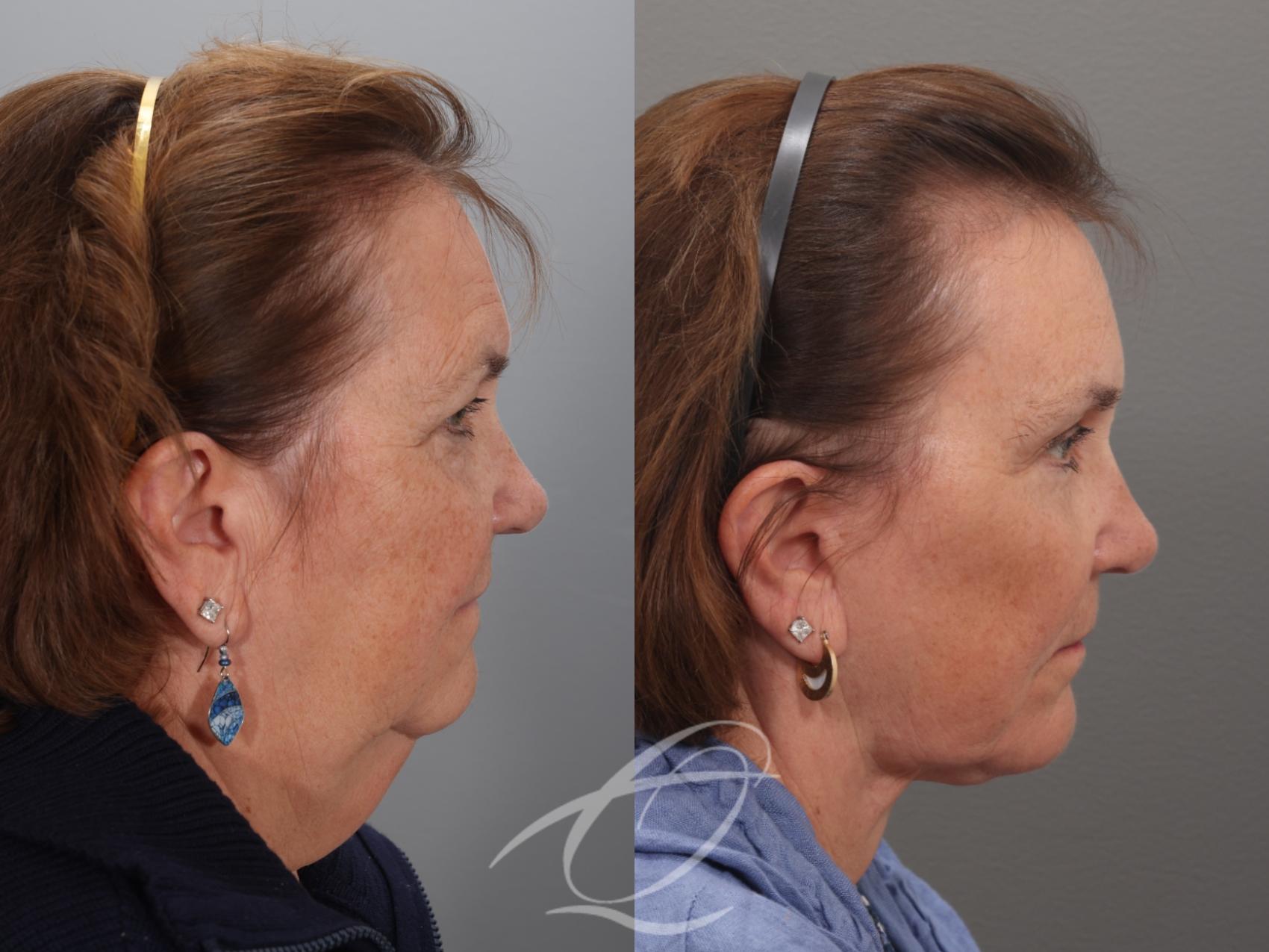 Facelift Case 1002034 Before & After Right Side | Serving Rochester, Syracuse & Buffalo, NY | Quatela Center for Plastic Surgery