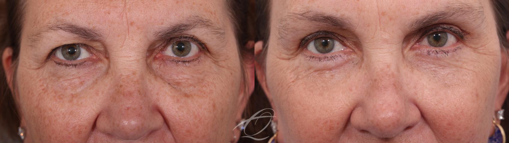 Facelift Case 1002034 Before & After Upper and lower blepharoplasty | Serving Rochester, Syracuse & Buffalo, NY | Quatela Center for Plastic Surgery