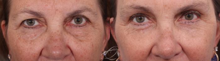Facelift Case 1002034 Before & After Upper and lower blepharoplasty | Serving Rochester, Syracuse & Buffalo, NY | Quatela Center for Plastic Surgery