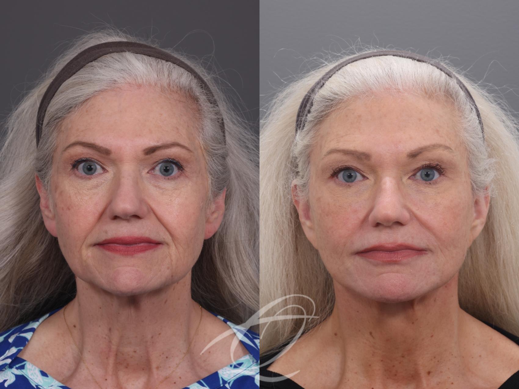 Facelift Case 1002069 Before & After Front | Serving Rochester, Syracuse & Buffalo, NY | Quatela Center for Plastic Surgery