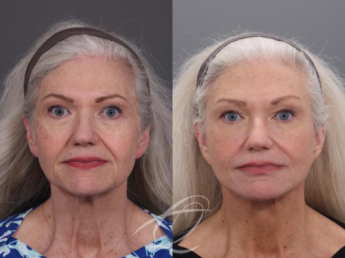 Facelift Case 1002069 Before & After Front | Serving Rochester, Syracuse & Buffalo, NY | Quatela Center for Plastic Surgery