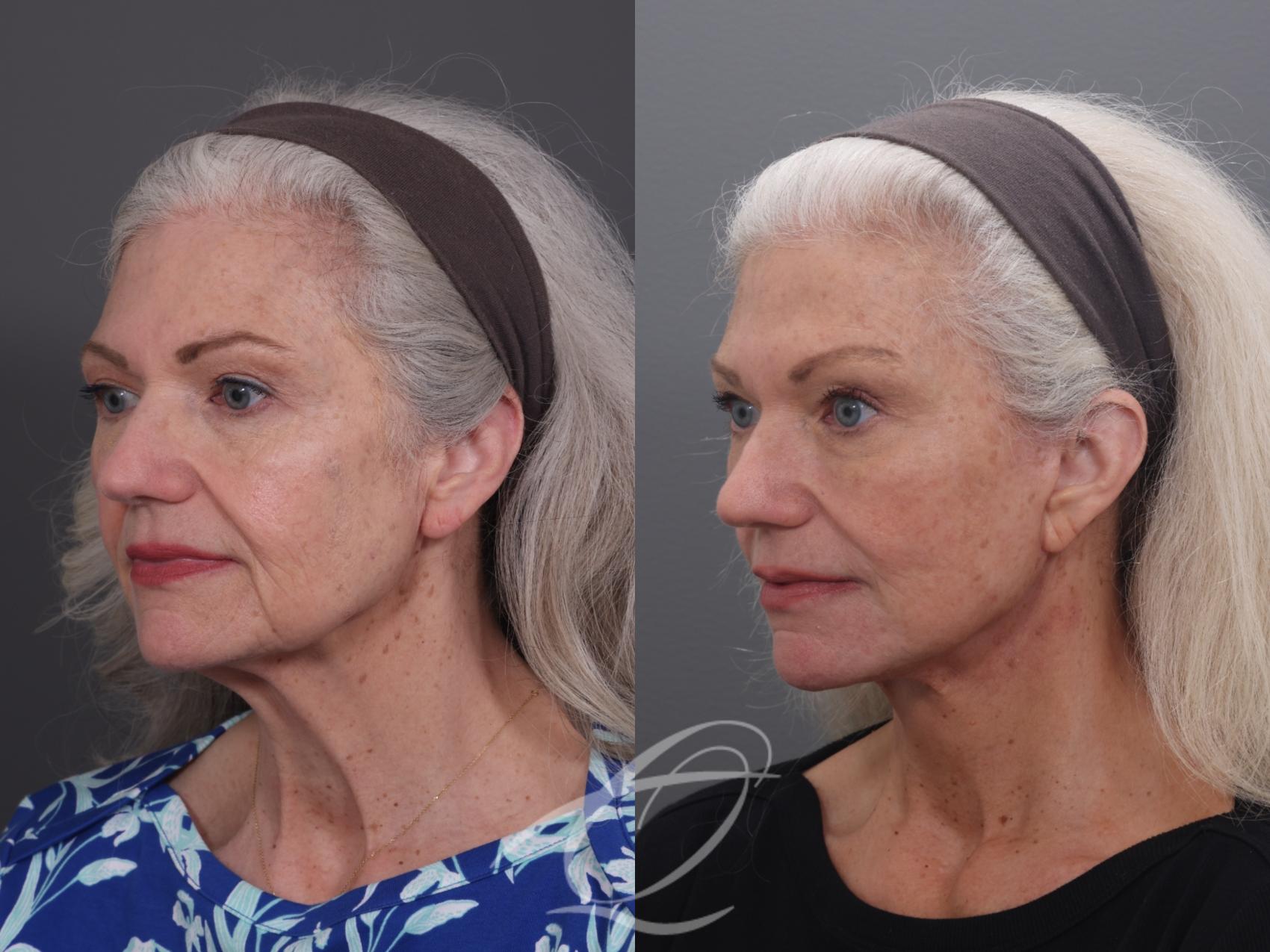 Facelift Case 1002069 Before & After Left Oblique | Serving Rochester, Syracuse & Buffalo, NY | Quatela Center for Plastic Surgery