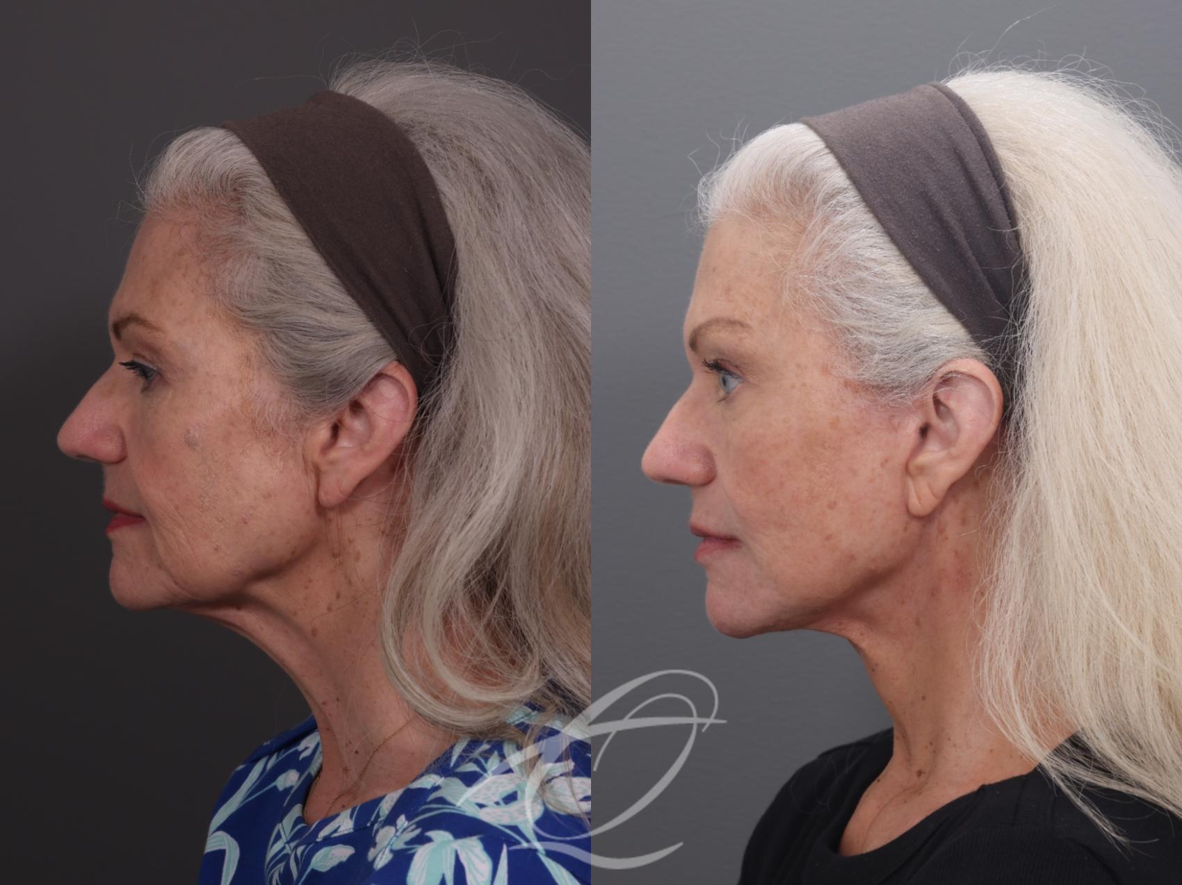 Facelift Case 1002069 Before & After Left Side | Serving Rochester, Syracuse & Buffalo, NY | Quatela Center for Plastic Surgery