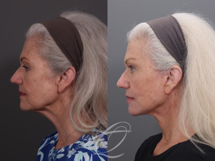 Facelift Case 1002069 Before & After Left Side | Serving Rochester, Syracuse & Buffalo, NY | Quatela Center for Plastic Surgery