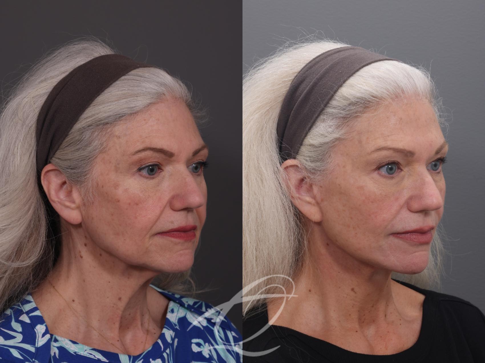 Facelift Case 1002069 Before & After Right Oblique | Serving Rochester, Syracuse & Buffalo, NY | Quatela Center for Plastic Surgery