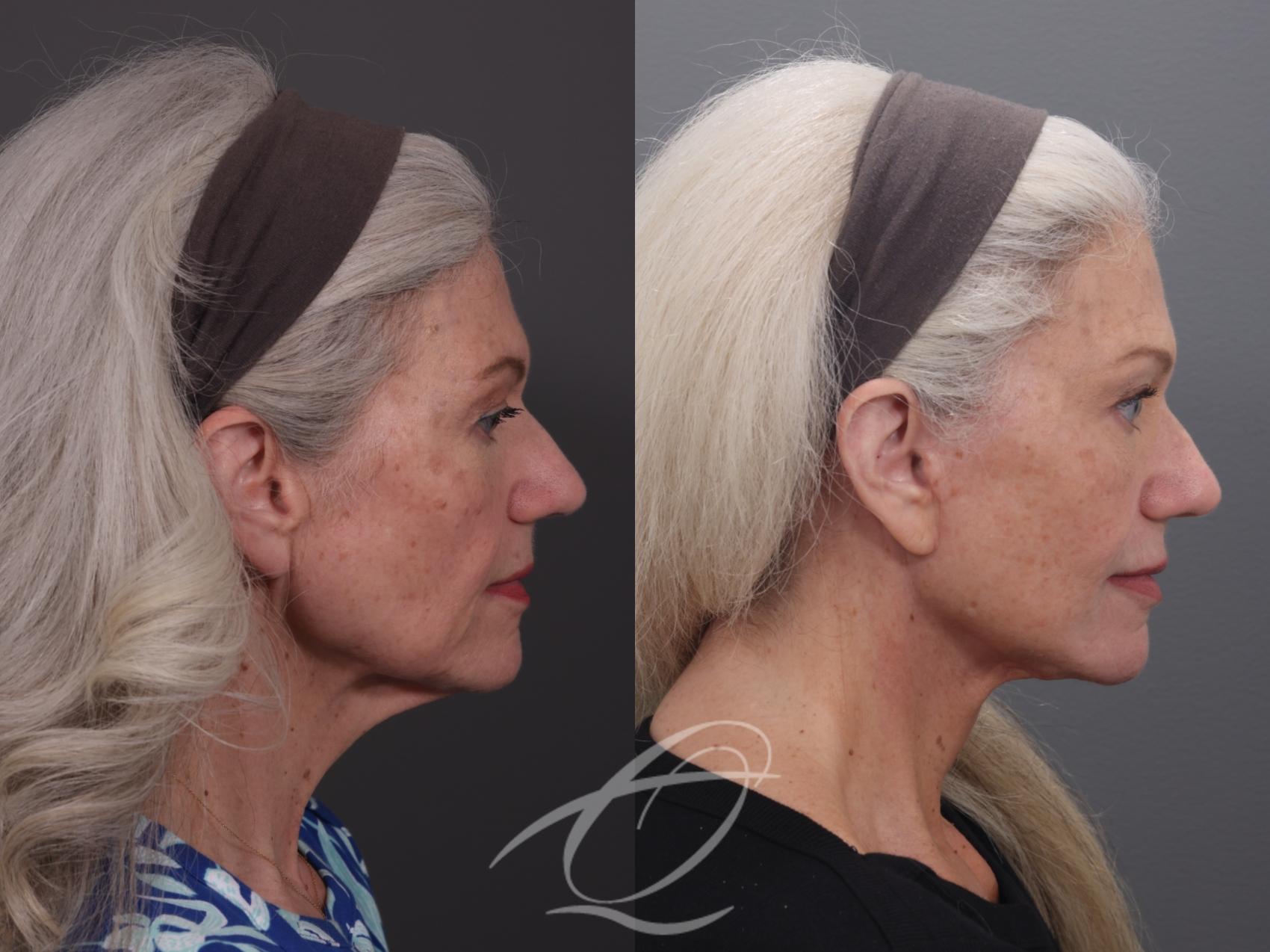 Facelift Case 1002069 Before & After Right Side | Serving Rochester, Syracuse & Buffalo, NY | Quatela Center for Plastic Surgery