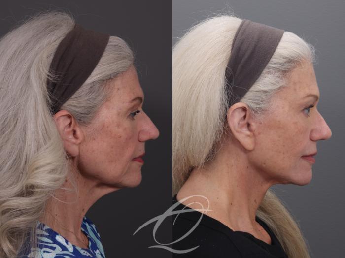 Facelift Case 1002069 Before & After Right Side | Serving Rochester, Syracuse & Buffalo, NY | Quatela Center for Plastic Surgery