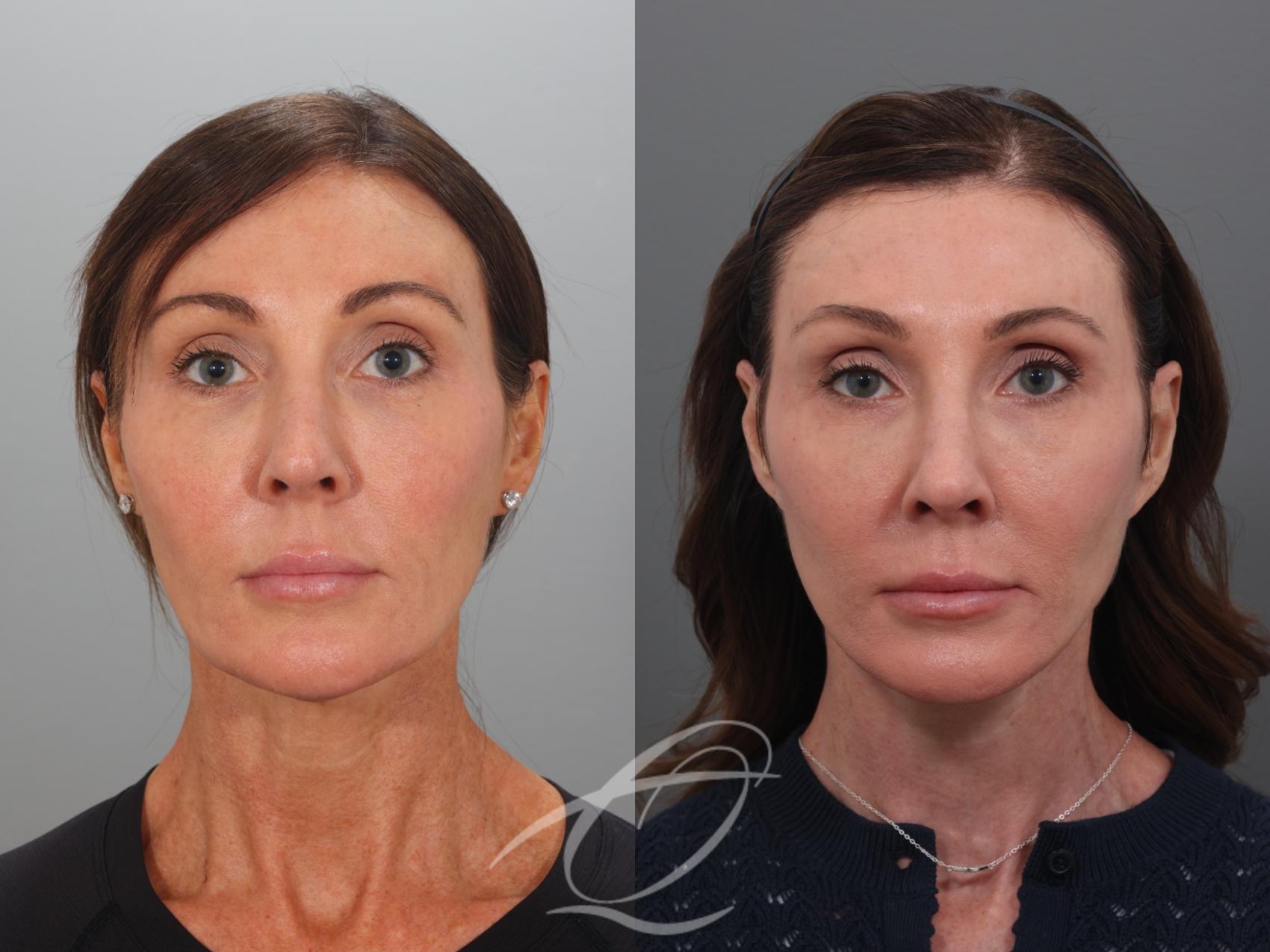 Facelift Case 1002078 Before & After Front | Serving Rochester, Syracuse & Buffalo, NY | Quatela Center for Plastic Surgery