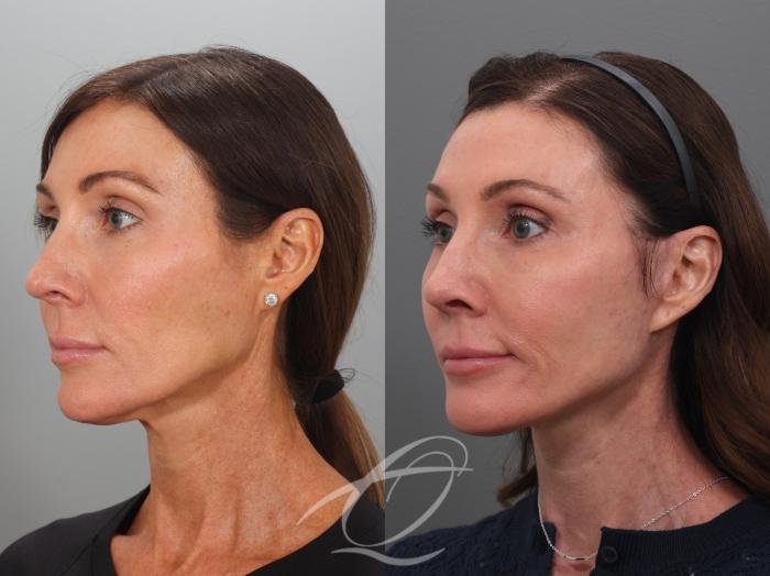 Facelift Case 1002078 Before & After Left Oblique | Serving Rochester, Syracuse & Buffalo, NY | Quatela Center for Plastic Surgery
