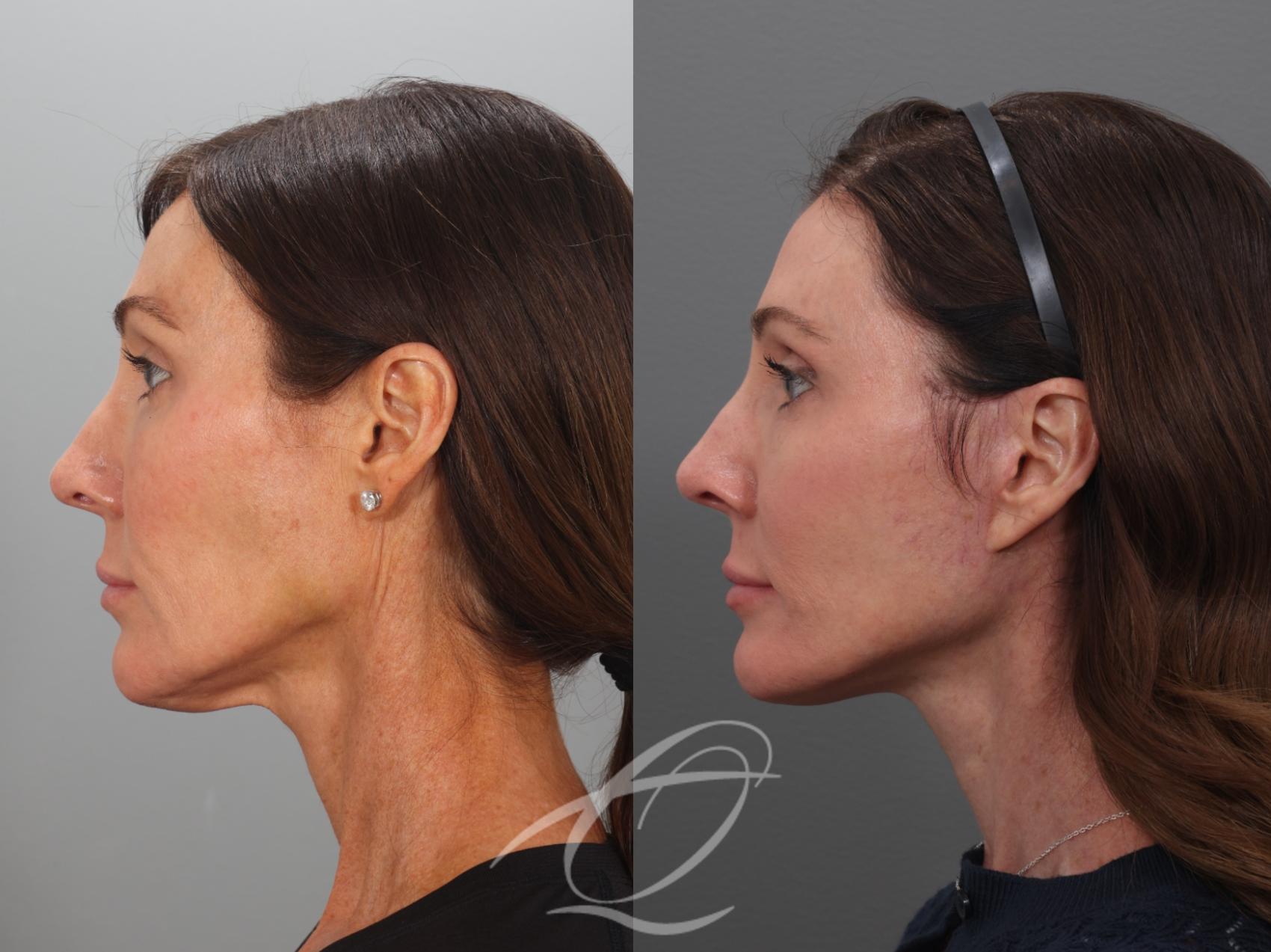 Facelift Case 1002078 Before & After Left Side | Serving Rochester, Syracuse & Buffalo, NY | Quatela Center for Plastic Surgery
