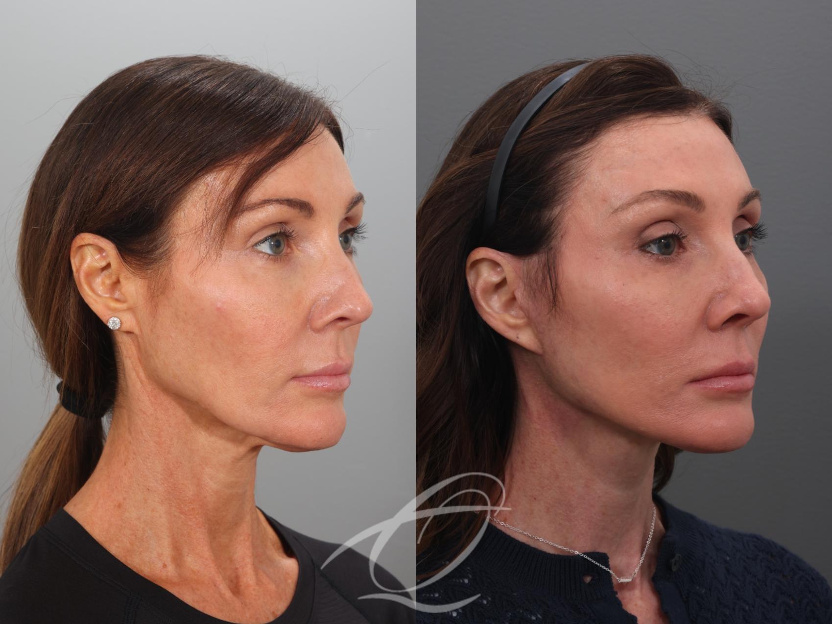 Facelift Case 1002078 Before & After Right Oblique | Serving Rochester, Syracuse & Buffalo, NY | Quatela Center for Plastic Surgery