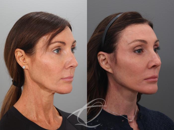 Facelift Case 1002078 Before & After Right Oblique | Serving Rochester, Syracuse & Buffalo, NY | Quatela Center for Plastic Surgery