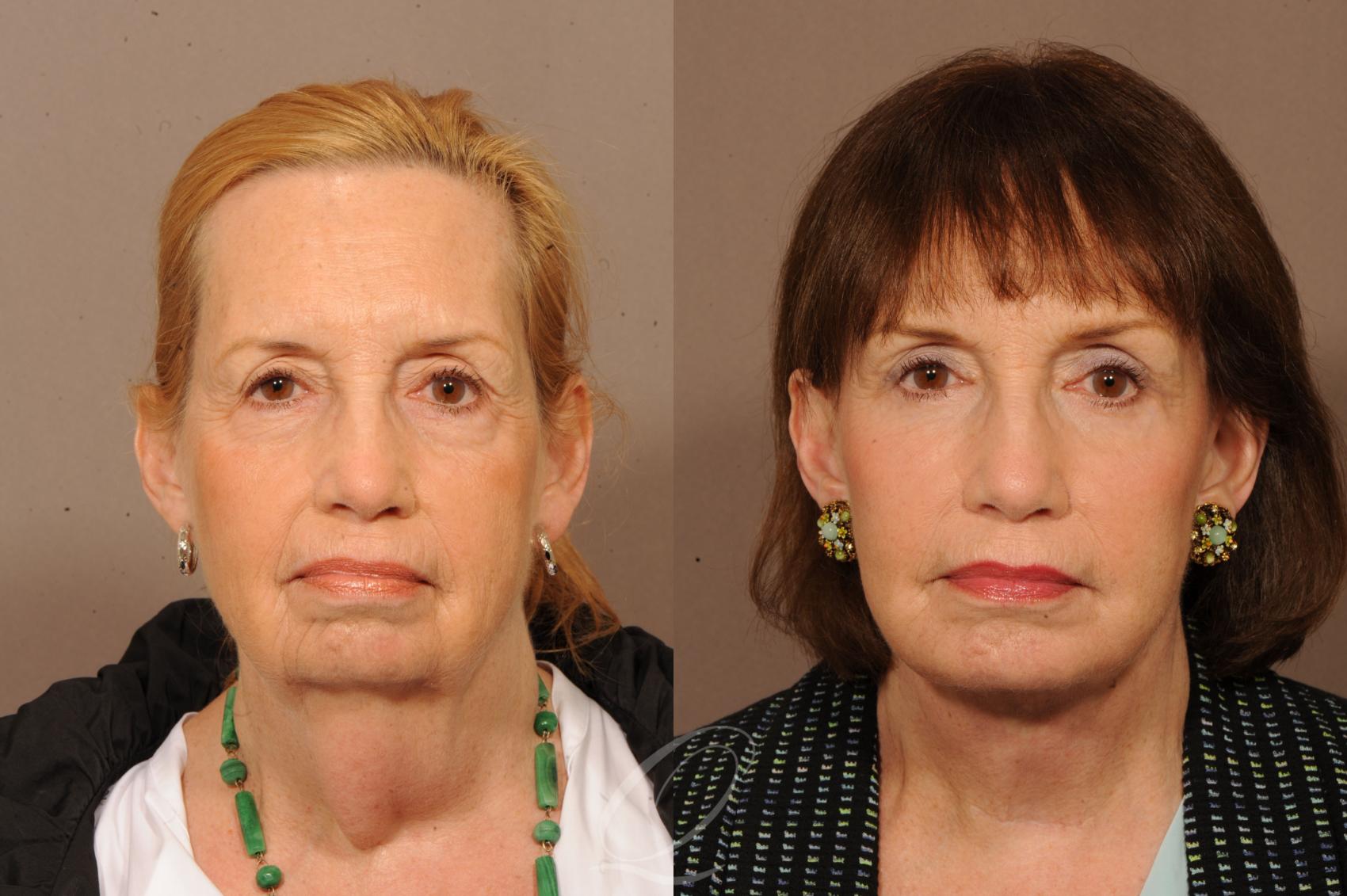 Facelift Case 1233 Before & After View #1 | Serving Rochester, Syracuse & Buffalo, NY | Quatela Center for Plastic Surgery