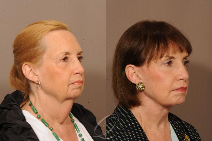 Facelift Case 1233 Before & After View #2 | Serving Rochester, Syracuse & Buffalo, NY | Quatela Center for Plastic Surgery