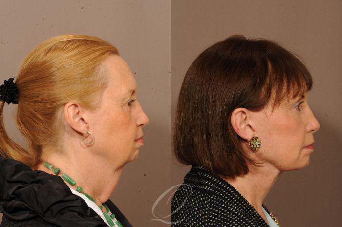 Facelift Case 1233 Before & After View #3 | Serving Rochester, Syracuse & Buffalo, NY | Quatela Center for Plastic Surgery