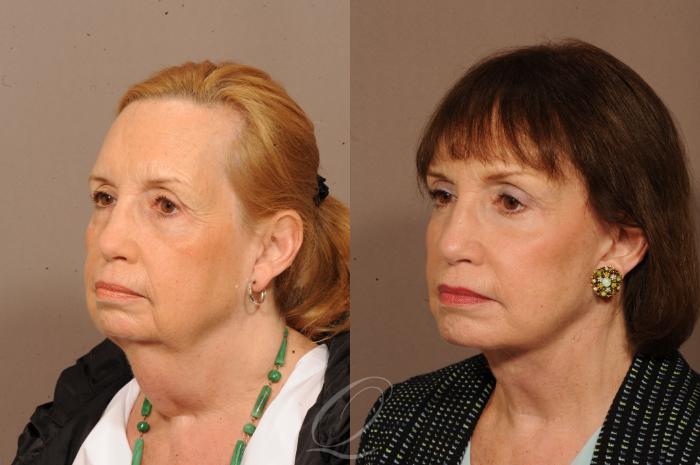 Facelift Case 1233 Before & After View #4 | Serving Rochester, Syracuse & Buffalo, NY | Quatela Center for Plastic Surgery
