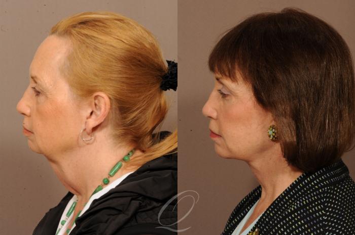 Facelift Case 1233 Before & After View #5 | Serving Rochester, Syracuse & Buffalo, NY | Quatela Center for Plastic Surgery