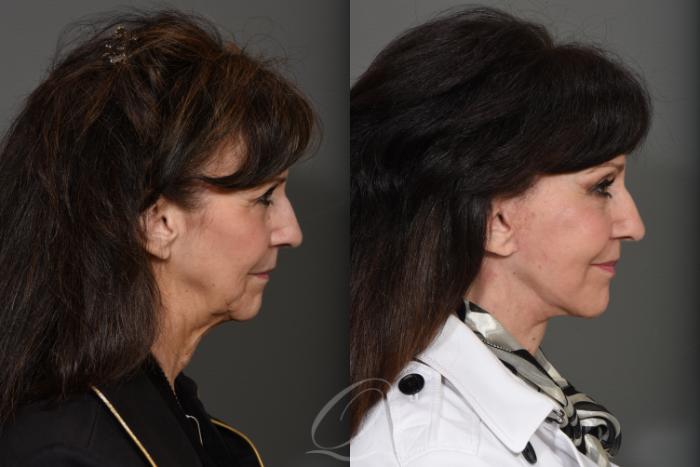 Brow Lift Case 1263 Before & After View #3 | Serving Rochester, Syracuse & Buffalo, NY | Quatela Center for Plastic Surgery