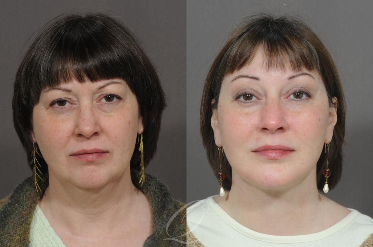 Facelift Case 294 Before & After View #1 | Serving Rochester, Syracuse & Buffalo, NY | Quatela Center for Plastic Surgery