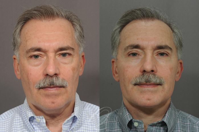 Facelift Case 13 Before & After View #1 | Serving Rochester, Syracuse & Buffalo, NY | Quatela Center for Plastic Surgery