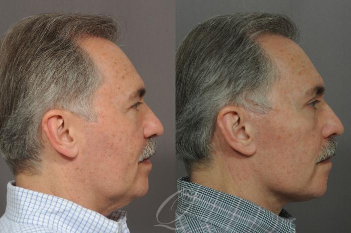 Facelift Case 13 Before & After View #2 | Serving Rochester, Syracuse & Buffalo, NY | Quatela Center for Plastic Surgery