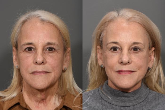 Eyelid Lift Case 1371 Before & After Front | Serving Rochester, Syracuse & Buffalo, NY | Quatela Center for Plastic Surgery