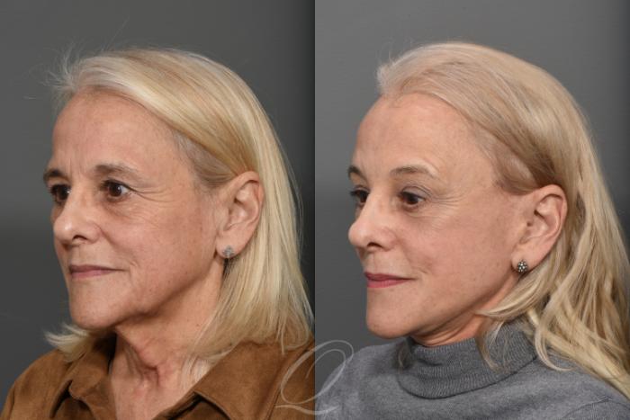 Facelift Case 1371 Before & After Left Oblique | Serving Rochester, Syracuse & Buffalo, NY | Quatela Center for Plastic Surgery