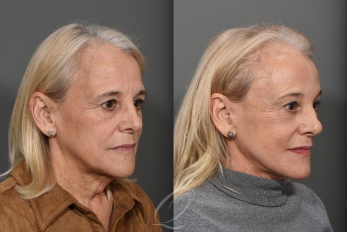 Facelift Case 1371 Before & After Right Oblique | Serving Rochester, Syracuse & Buffalo, NY | Quatela Center for Plastic Surgery