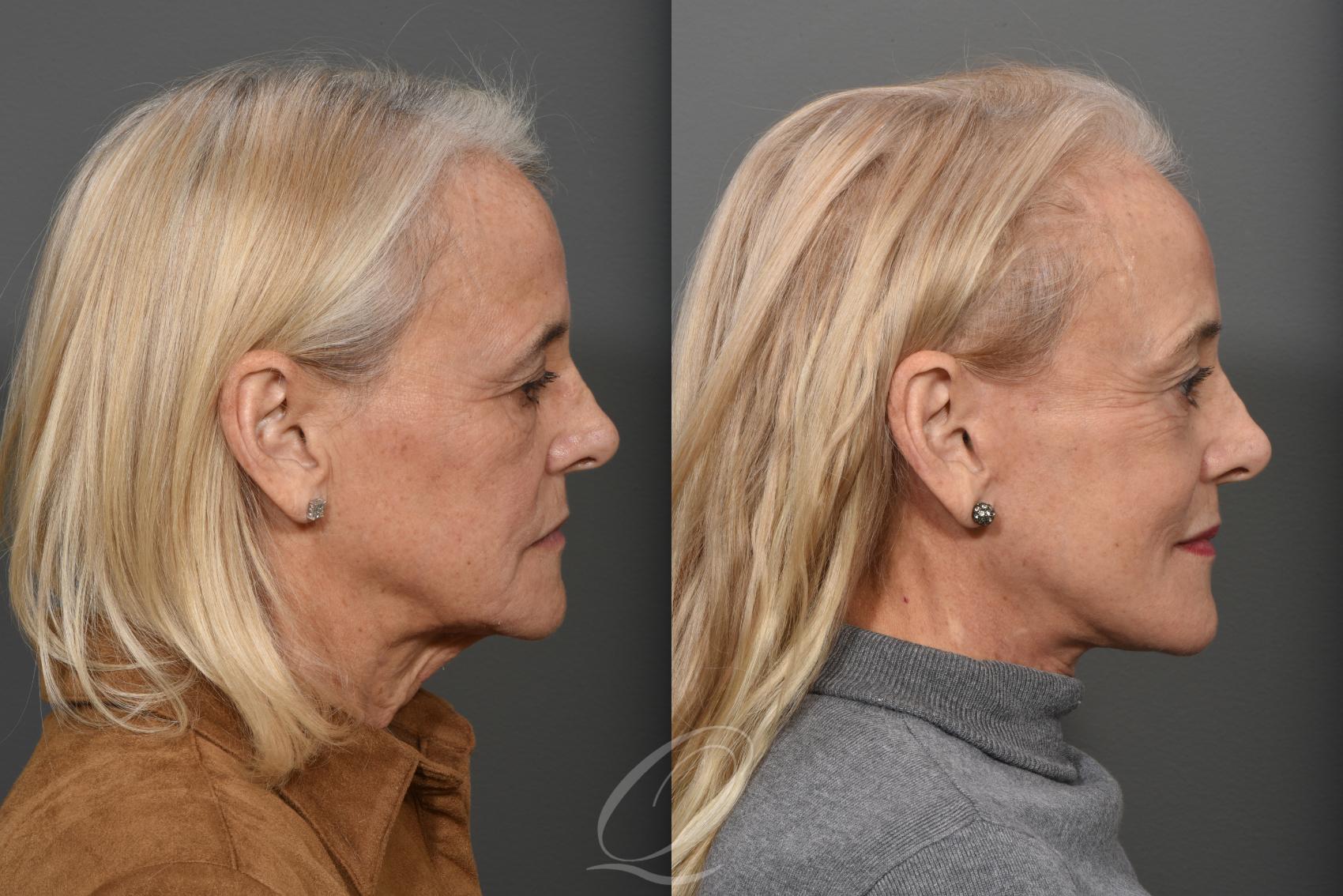 Facelift Case 1371 Before & After Right Side | Serving Rochester, Syracuse & Buffalo, NY | Quatela Center for Plastic Surgery