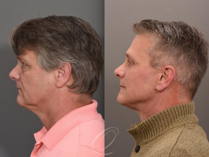 Facelift Case 1410 Before & After Left Side | Serving Rochester, Syracuse & Buffalo, NY | Quatela Center for Plastic Surgery