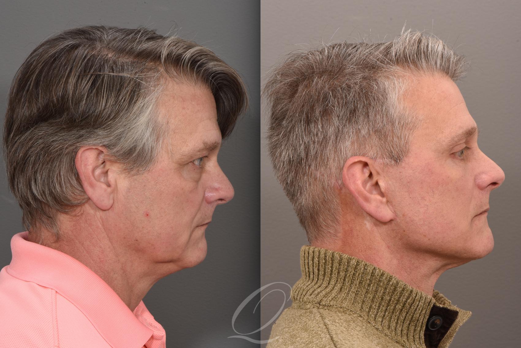 Brow Lift Case 1410 Before & After Right Side | Serving Rochester, Syracuse & Buffalo, NY | Quatela Center for Plastic Surgery