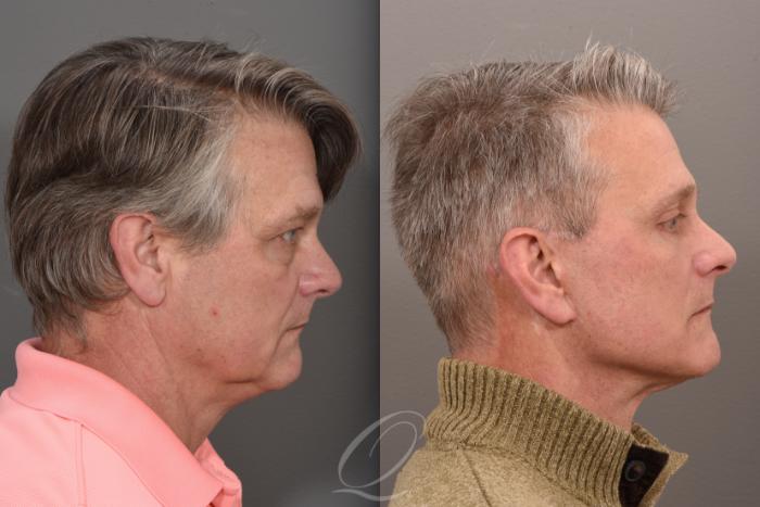 Facelift Case 1410 Before & After Right Side | Serving Rochester, Syracuse & Buffalo, NY | Quatela Center for Plastic Surgery